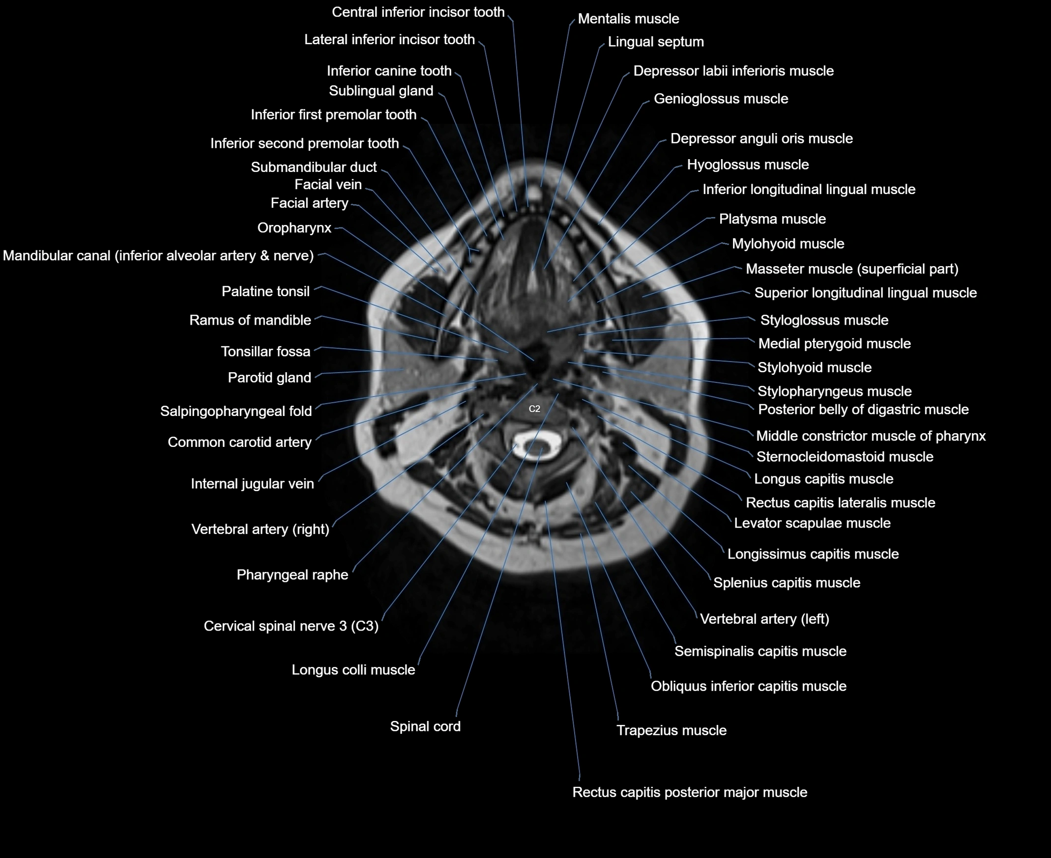 MRI Neck 3D labelled cross section anatomy axial 3t image-00001-00037.webp